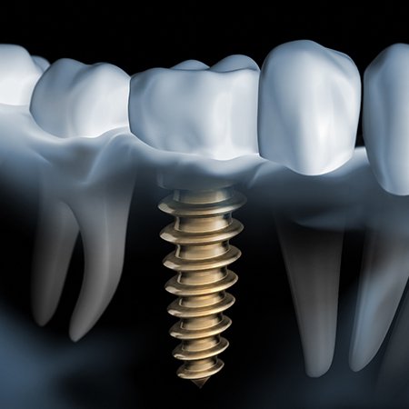 3D illustration of a dental implant in Longview surrounded by teeth