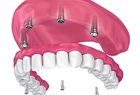 illustration of implant denture being placed on the upper arch