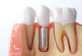 model of a dental implant in the jaw