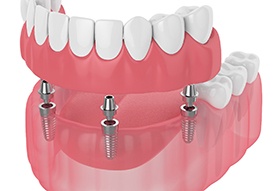 A digital illustration of implant dentures on a white background