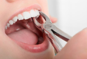 woman mouth open for tooth extraction